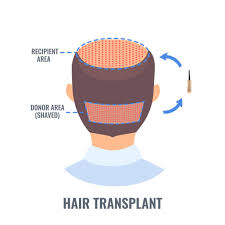 Hair Transplant $2200 